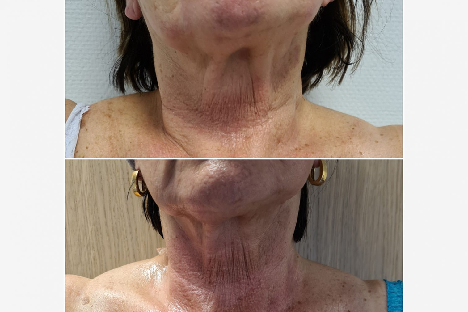 Soin RADIOFRÉQUENCE